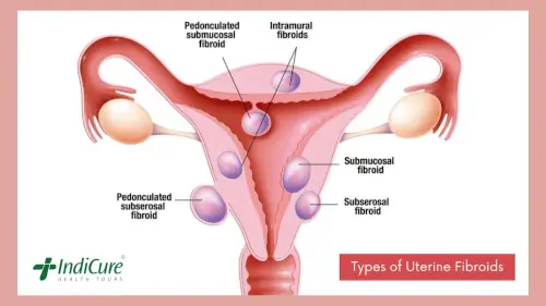 Types of Uterine Fibroids